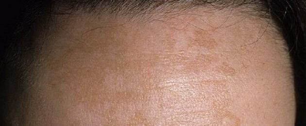 Кто смог избавиться от мелазмы. Гиперпигментация кожи – причины, лечение, мелазмы типа хлоазма, поствоспалительная гиперпигментация