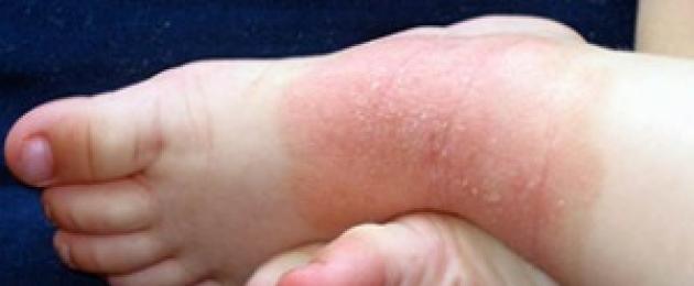 Атопический дерматит у детей: как его полностью вылечить. Атопический дерматит у детей: лечение, причины, симптомы, препараты