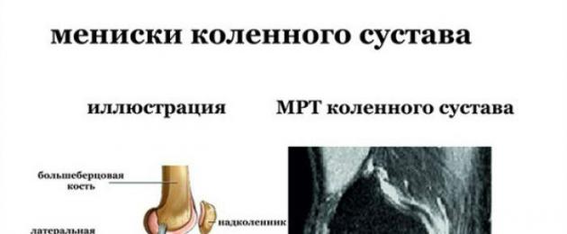 Показания к проведению мрт суставов. Что такое МРТ коленного сустава, как делают, что покажет МРТ коленного сустава? Показания для МРТ суставов