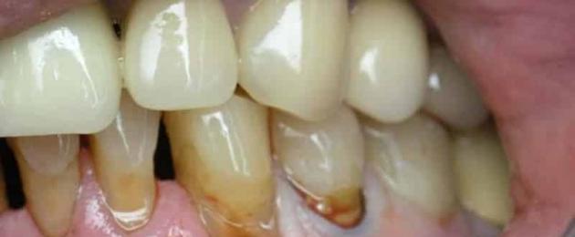 От чего темнеют зубы. Отбеливание зубов в клинике — плюсы и минусы