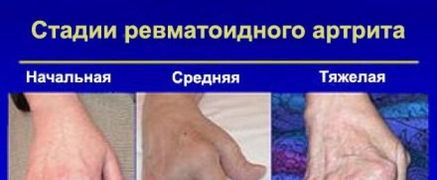 Артрит на пальцах рук. Причины и симптомы возникновения артрита пальцев рук