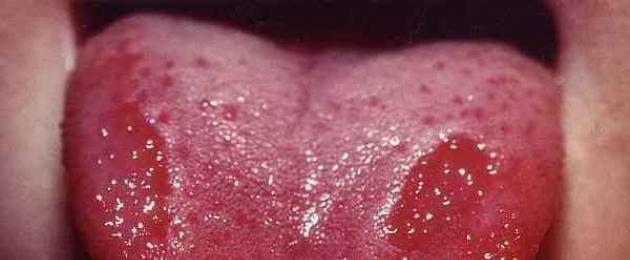 Fai dei puntini rossi sulla lingua.  Igiene orale: rivisitare i rituali mattutini