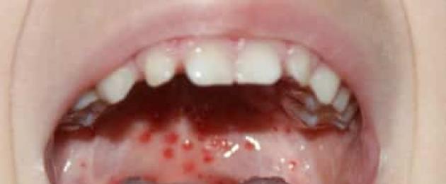 La gola è rossa con macchie rosse.  Quanto è pericolosa un'eruzione cutanea in gola: sintomi associati, diagnosi, trattamento