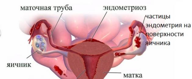 Эндометриоидная киста яичника: лечение, операция, народные средства, лечение без операции. Болезнь яичников — эндометриоидная киста