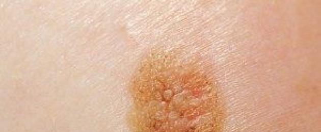 Il melanoma segnala i sintomi.  Melanoma lentigo o lentigo maligna