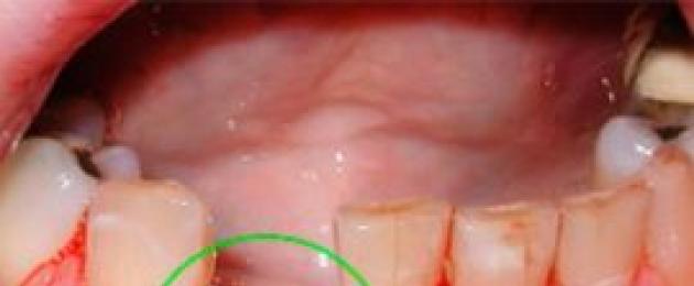 Болит десна после того, как выдернули зуб, что делать? Что нужно делать после удаления зуба. 