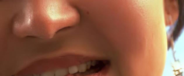 Причины появления и способы лечения заед на губах. Заеды в уголках рта – причины, виды и лечение заедов рта