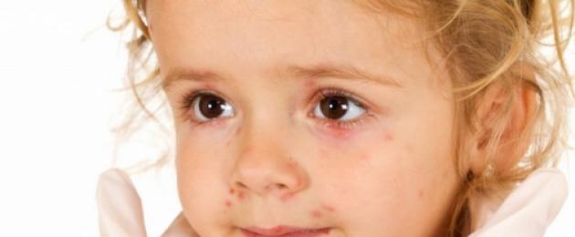 Все виды сыпи на лице у детей с пояснениями и фото: причины появления прыщиков и способы лечения. Причины появления прыщиков у грудничка на щеках