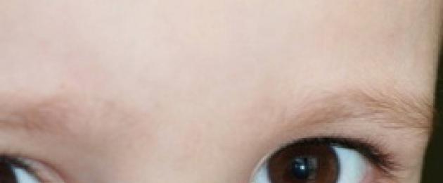 قائمة أمراض العيون عند الأطفال.  أمراض العيون