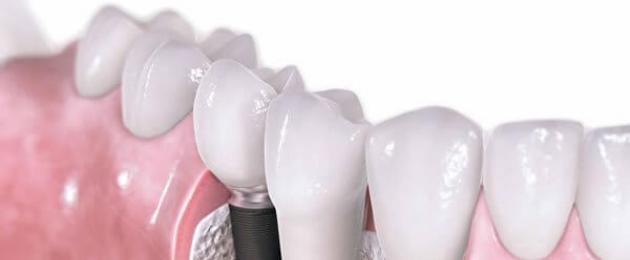 Стоит ли ставить имплант зуба? В чем опасность имплантации зубов. 