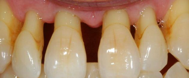 Оголенная шейка. Оголение шейки зуба: причины и лечение