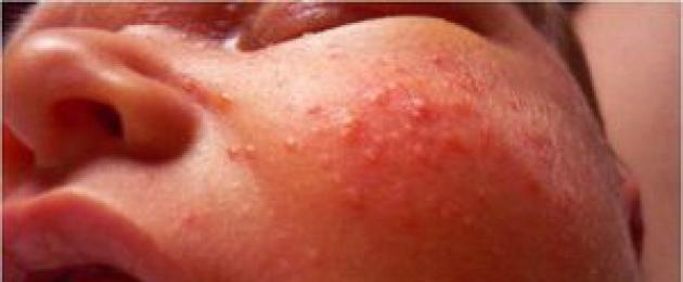 Eruzione cutanea rossa e ruvida in un bambino.  Malattia 