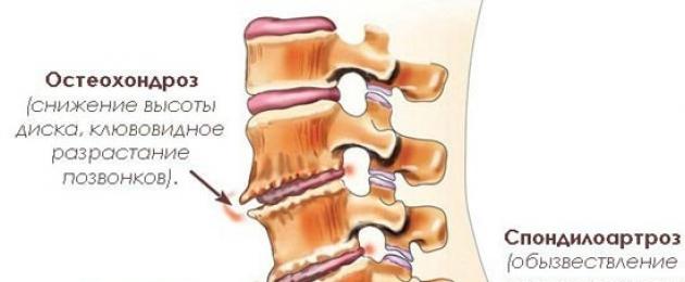 Сильные боли в спине при движении. Почему болит спина и как ее лечить? Боль в области шеи чаще всего является периодической, но случается, что она возникает по причине серьезных нарушений, таких как