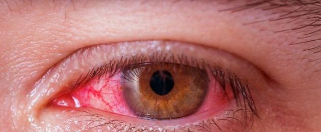 Заболевания глаз: как лечить конъюнктивит, ячмень и блефарит. В чем различие между ячменем и коньюктивитом Как лечить ячмень и коньюктивит