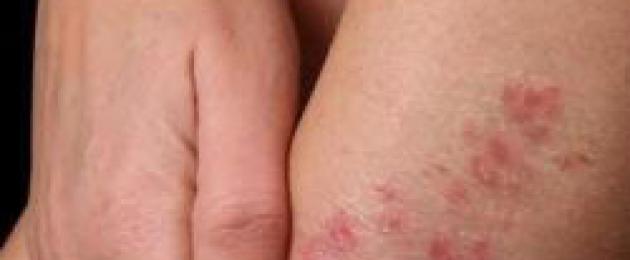 Trattamento dermatite alle dita dei piedi.  Metodi di trattamento della dermatite nelle vene varicose.  Trattamenti fisioterapici