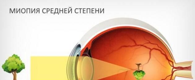 Лечение миопии средней. Что такое миопия глаза слабой или средней степени и как ее вылечить
