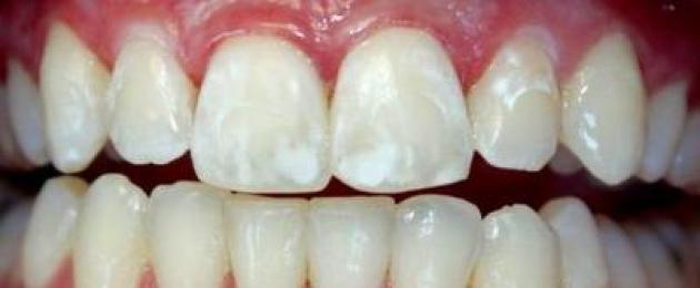 Come puoi sbiancare i denti a casa in sicurezza?  Impacchi di panna acida.  Prodotti professionali per lo sbiancamento dei denti