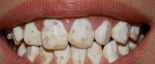Гипоплазия зубов. Как устранить гипоплазию эмали зубов: происхождение и лечение патологии