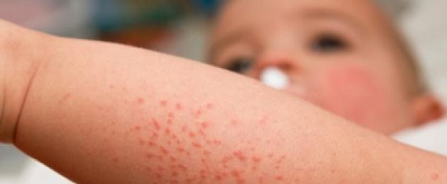 Quali farmaci antiallergici sono adatti ai bambini?  Eruzione allergica.