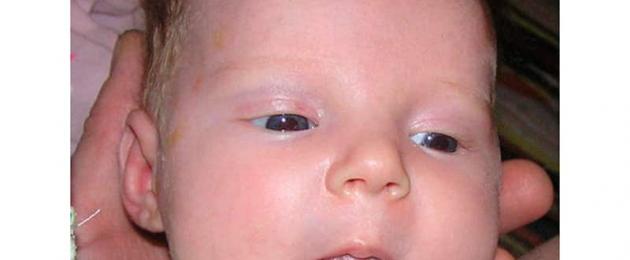 Rivestimento bianco sulla lingua di un bambino che allatta al seno Komarovsky.  Perché un bambino ha una patina bianca sulla lingua: cause e trattamento