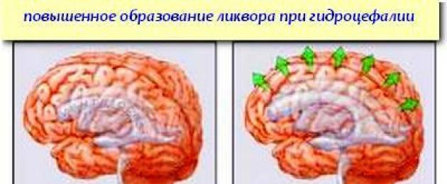 Расширение желудочков дети. Гипертензионный синдром головного мозга. Строение головного мозга человека желудочки. Мозг человека строение гидроцефалией. Расширение желудочков головного мозга.