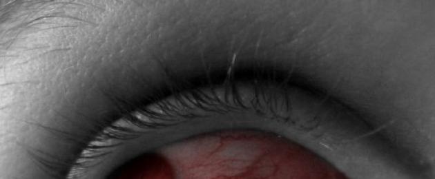 Раскрываем секрет, как избавиться от красных сосудов в глазах. Почему появляются красные капилляры в глазах