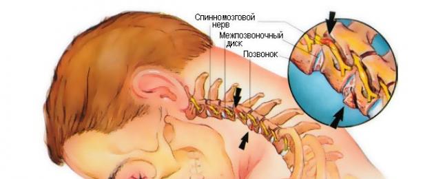 Iniezioni per un nervo schiacciato nella regione cervicale.  Nervo schiacciato nella regione cervicale: sintomi