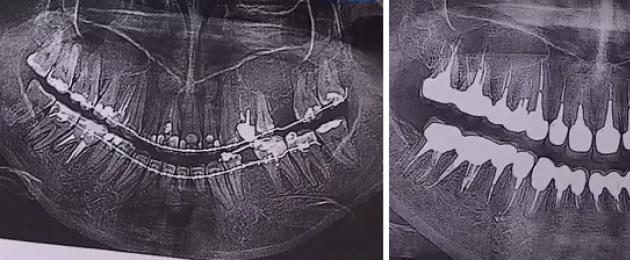 Il medico tirò fuori 22 denti sani.  Pensionati militari per la Russia e le sue forze armate
