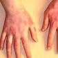 Как проявляется дерматит на руках: фото, симптомы и способы лечения
