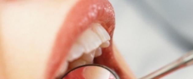 Воспаление ротовой слизистой. Болезни полости рта: причины, симптомы и лечение