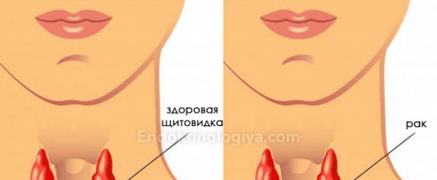Trattamento della cisti paratiroidea.  Cisti tiroidea: cause di formazione e possibili complicanze