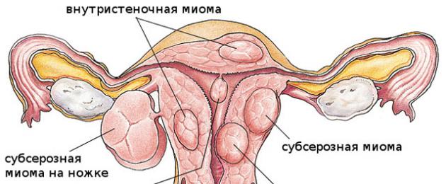 Come appaiono i fibromi uterini di grandi dimensioni?  Crescita dei fibromi uterini: cause e misure di prevenzione.