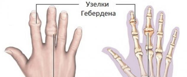 Узелки бушара лечение. Узелки Гебердена ревматоидный артрит. Узелки Гебердена и Бушара ревматоидный артрит. Узелки Гебердена заболевание. Узелки Гебердена и Бушара на ногах.