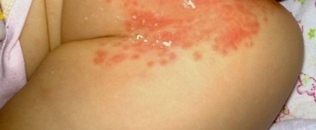 Кандидозный пеленочный дерматит. Лечение кандидозного дерматита у детей и взрослых