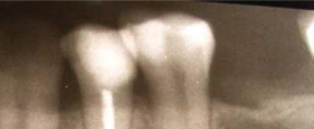 Зубные гранулёмы. Все методы лечения гранулемы зуба