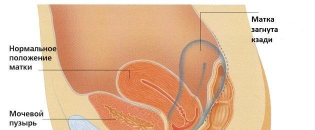Curvatura della cervice: come intraprendere il percorso verso la maternità, quali posizioni aiuteranno il successo del concepimento?  Posture efficaci per il concepimento quando l'utero è piegato all'indietro.