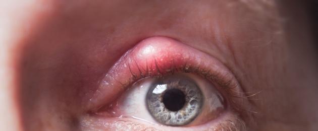 Nomi e sintomi delle malattie degli occhi nell'uomo.  Malattie degli occhi: cause, sintomi, trattamento delle malattie degli occhi