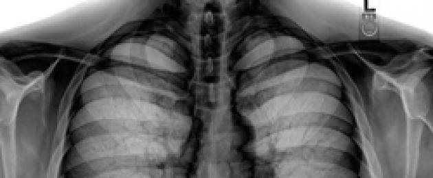 Radiografia della costola.  L'esame radiografico delle costole come miglior metodo diagnostico