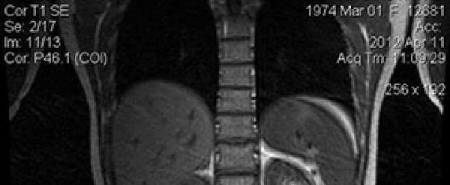 RM dei calcoli biliari.  Esame MRI della cistifellea