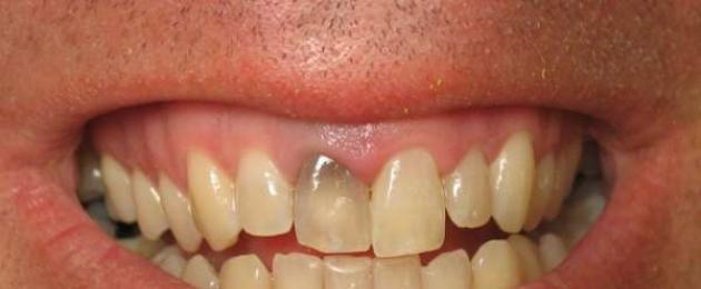 От чего могут почернеть зубы. Почему чернеют зубы? Как удалить на зубах черный налет в домашних условиях