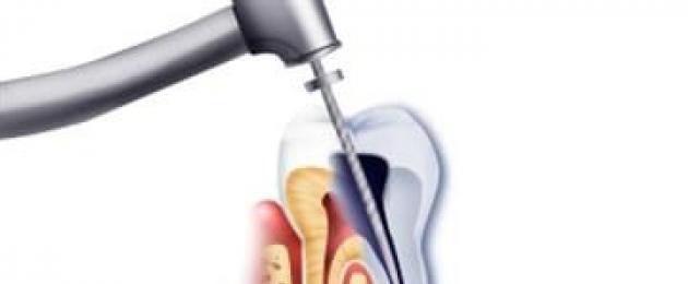 Удаление нерва под коронкой. Что делать, если болит зуб под коронкой при надавливании? Некачественная подготовка к протезированию