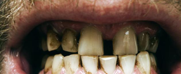 Почернели зубы: причины, что делать. Потемнение эмали зубов