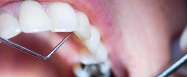 Как отбелить зубы в домашних условиях без вреда? — Лучшие советы. Нюансы безопасного отбеливания в домашних условиях