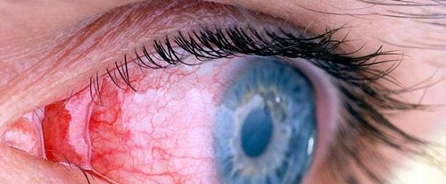 Отек роговицы глаза после операции катаракты. Отек после операции катаракты Отек век после замены хрусталика глаза