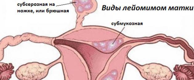 ما هو الورم العضلي الأملس الرحمي - الأسباب والعلاج.  كيف تؤثر الأورام الليفية الرحمية على الحمل؟ هناك عدة أنواع من تصنيف الأورام العضلية الملساء