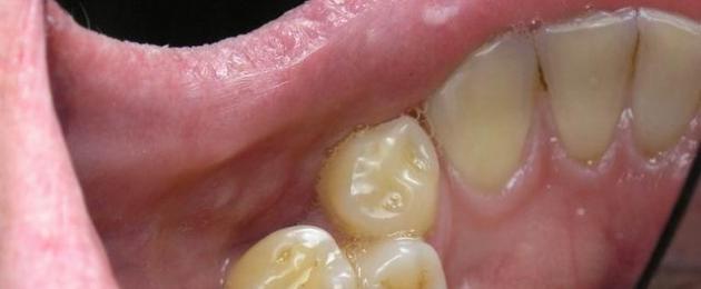 Дистопия зуба. Выравнивание зубов