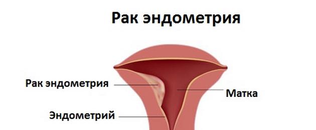 Симптомы рака матки. Рак матки: первые признаки и симптомы, лечение на ранней стадии