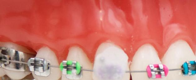 È possibile mangiare con la cera sull'apparecchio?  Cera per apparecchi ortodontici: benefici e regole d'uso