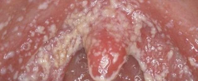 Quali sono i segni della tonsillite purulenta?  Caratteristiche della malattia nei bambini