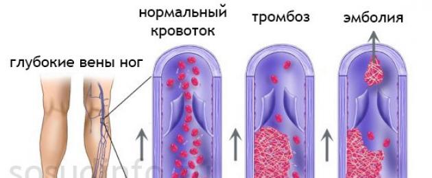 Послеоперационный тромбоз. Профилактика тромбоэмболии